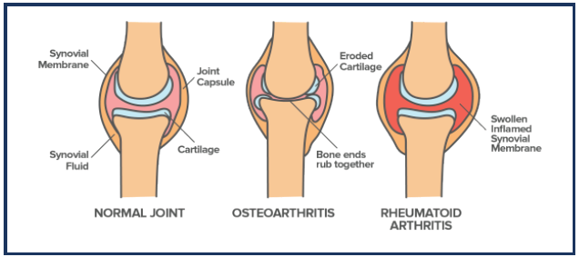 Low Dose Radiotherapy for Osteoarthritis Low Dose Radiotherapy for Osteoarthritis