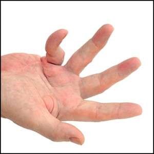 Dupuytren’s Contracture Treatment: Low-Dose Radiotherapy Dupuytren’s Contracture Treatment: Low-Dose Radiotherapy