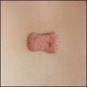 Radiation Therapy to Reduce Keloid and Hypertrophic Scars