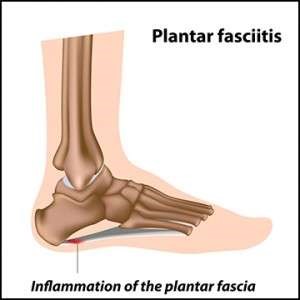 Low Dose Radiotherapy for Plantar Fasciitis Relief
